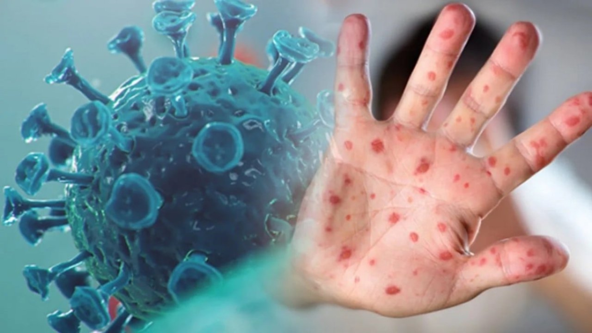 gebelikte maymun çiçeği