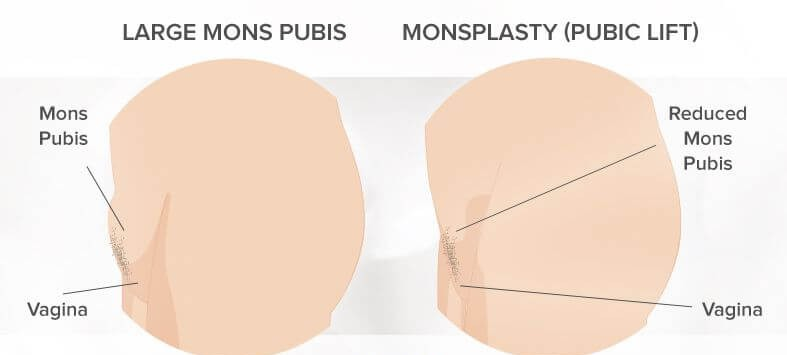 Monsplasty