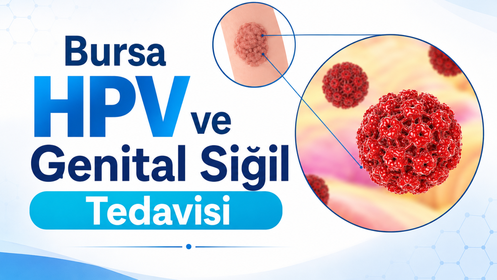 bursa-hpv-ve-genital-sigil-tedavisi