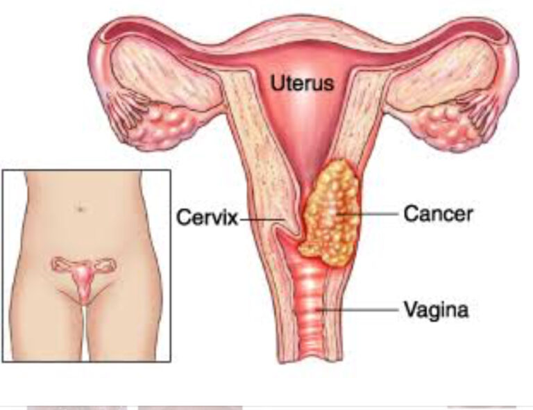 rahim-agzi-kanseri-768x590